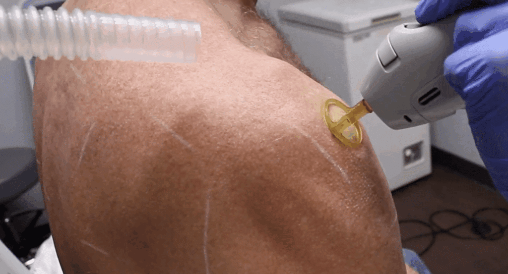 Shoulders Laser Men