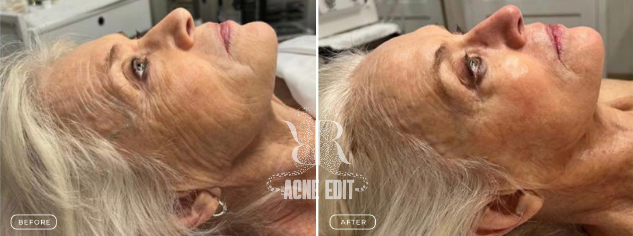 Side-by-side comparison of a woman's face showing skin improvements before and after acne treatment, with visible reduction in wrinkles and clearer skin.