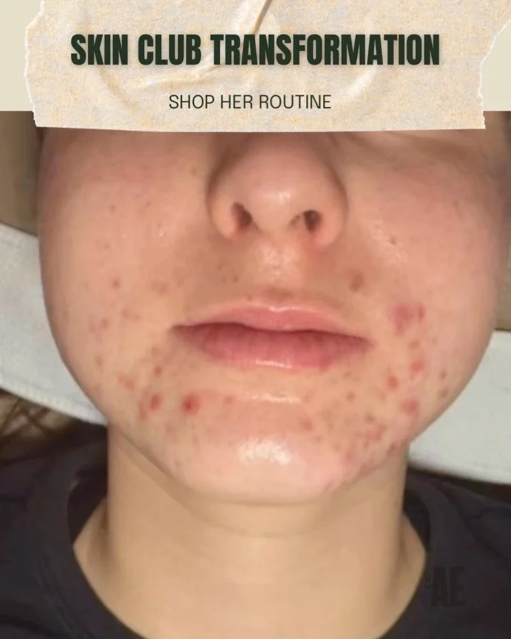 From &ldquo;Help me pls&rdquo; to &ldquo;WOW YOUR SKINS GLOWING✨ plus the breakdown of her acne coded routine that did not come to play.

Because yes&hellip; the transformation is cute,
but the real magic?Consistency, ingredients that actually work, 