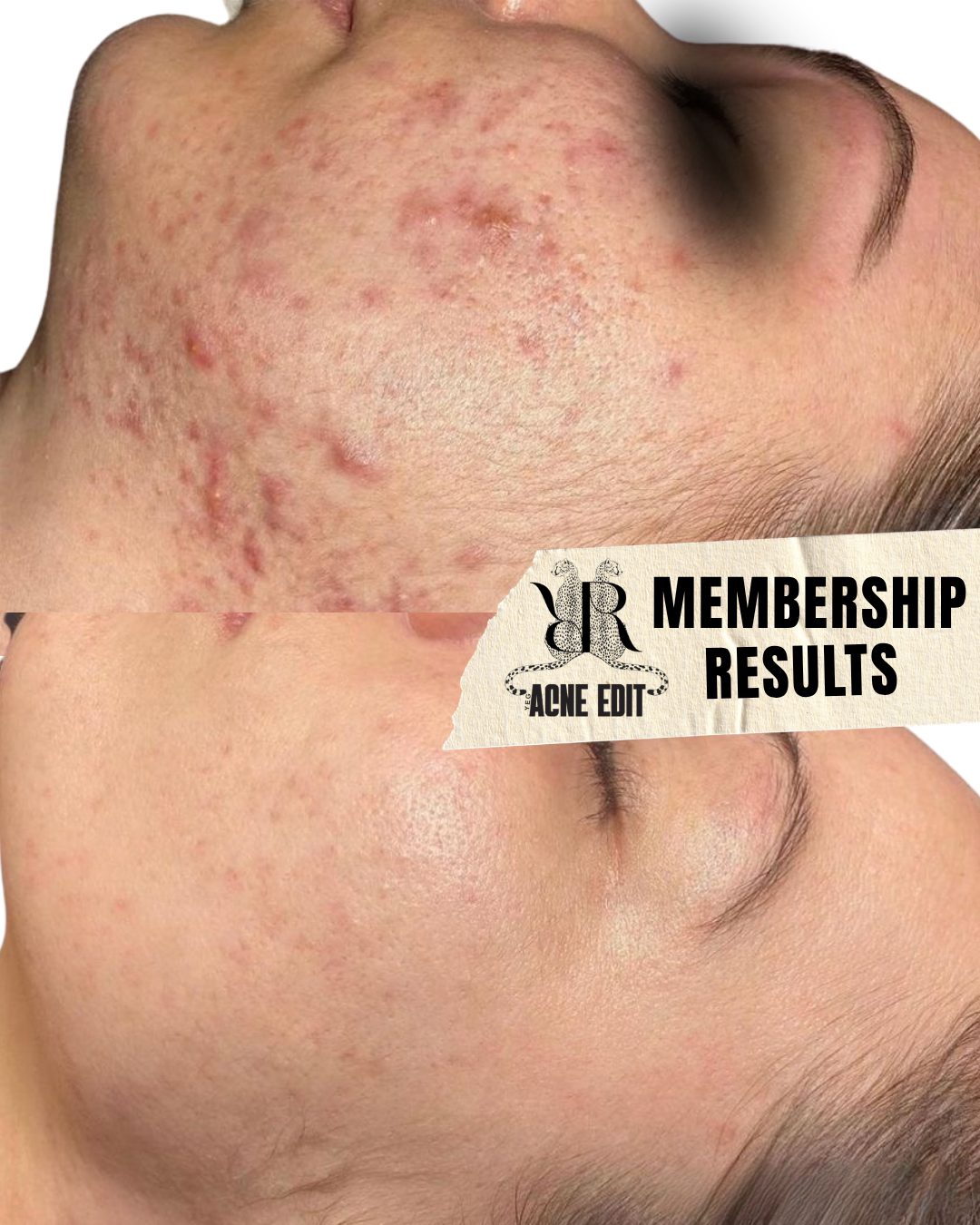Before and after comparison of skin, showing reduced acne and smoother texture as a result of treatment, with a label indicating 'Membership Results' from Acne Edit.