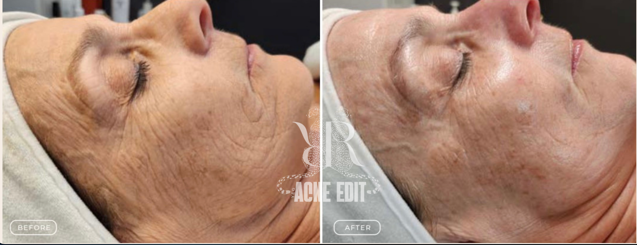 Side-by-side comparison of a person's face with visible wrinkles before and after skin treatment, showing reduced wrinkles and improved skin appearance.