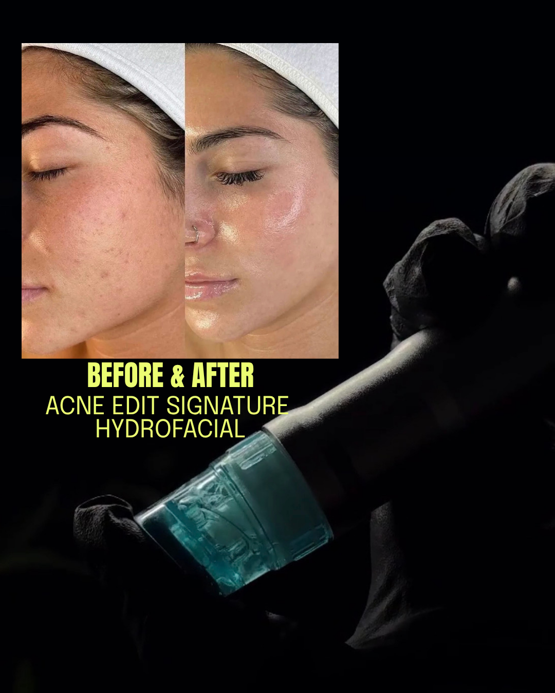 Acne Edit Signature Hydrofacial  (Package of 3)