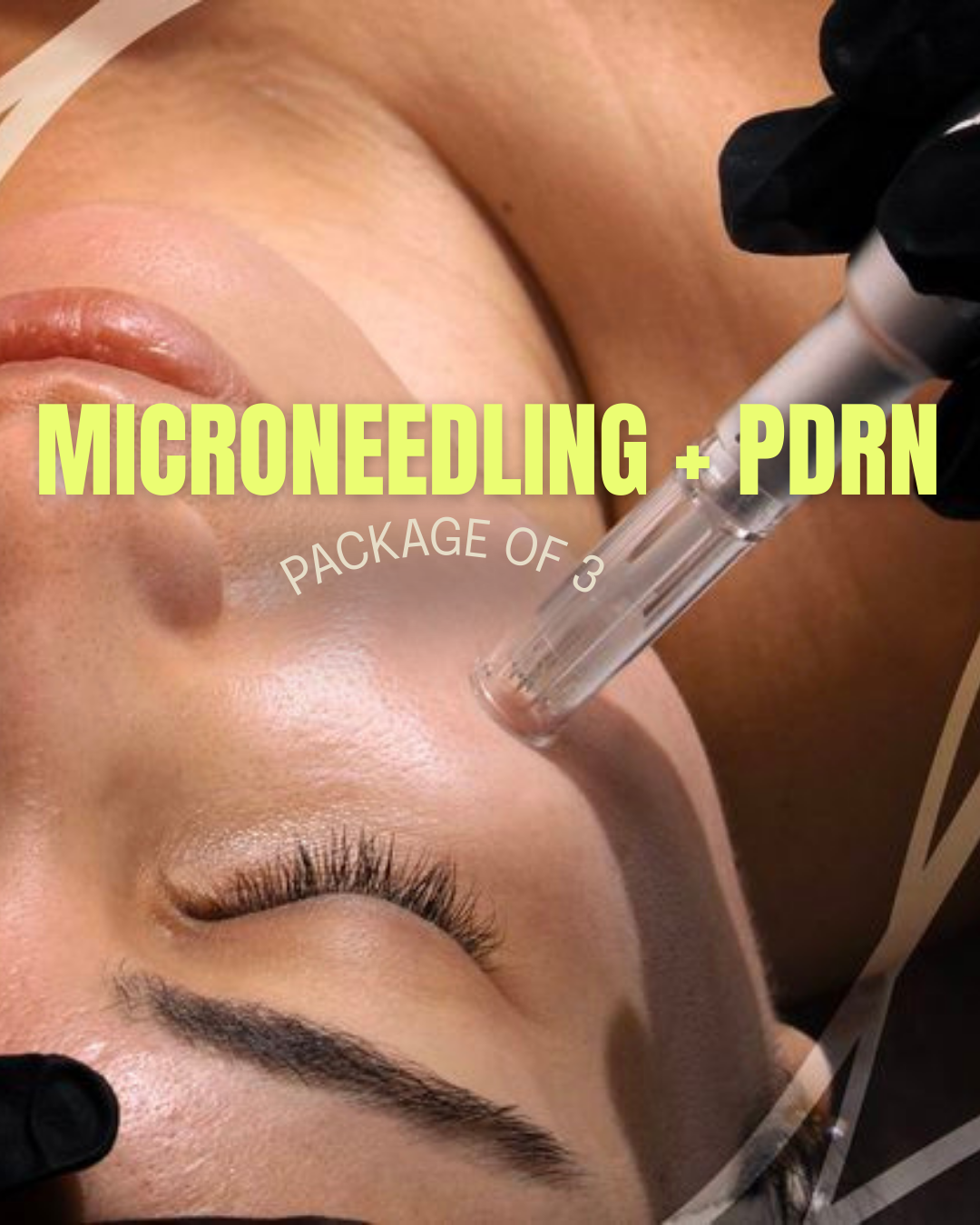 Microneedling + PDRN ( 3 treatments)