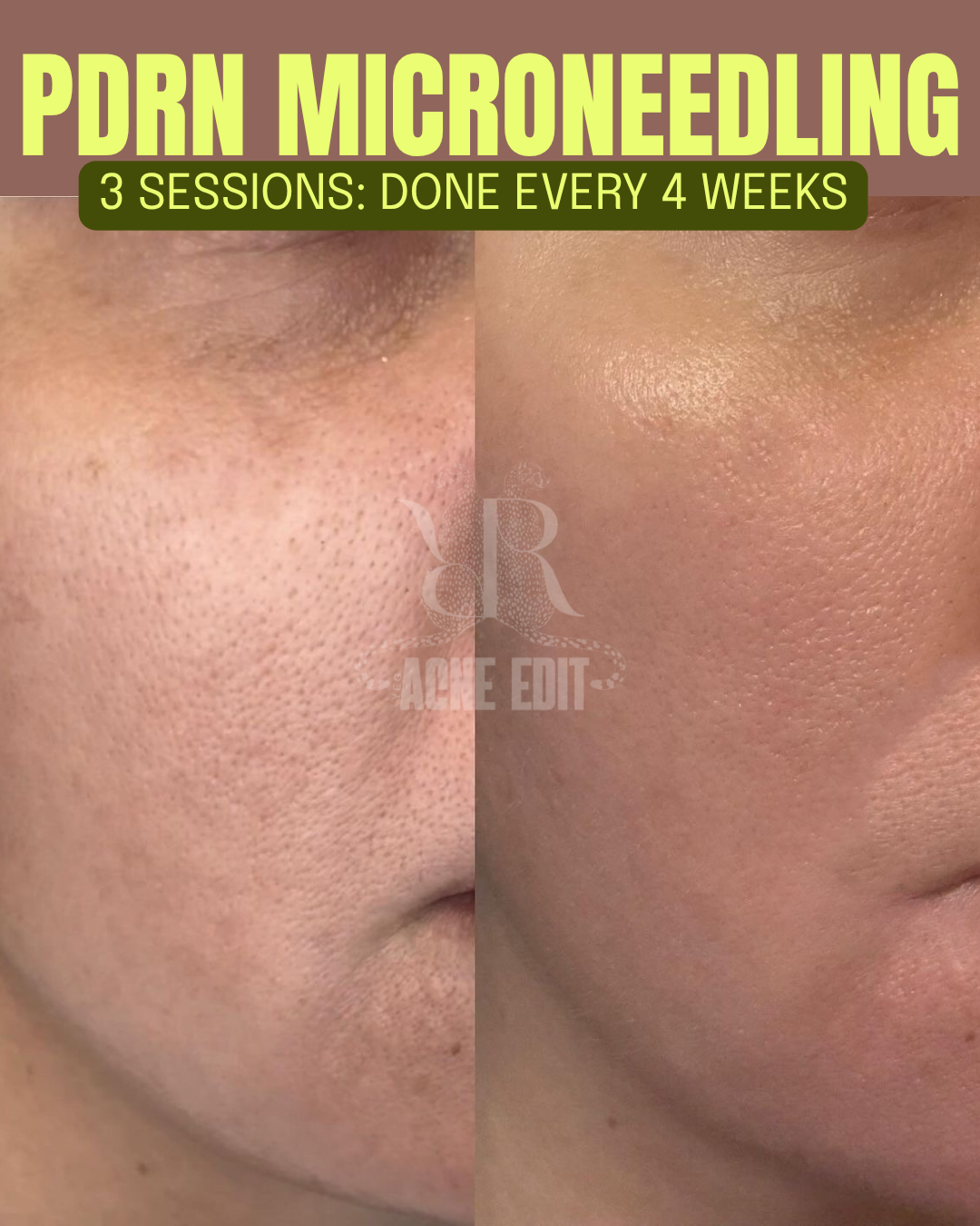 Microneedling + PDRN (3 treatments)