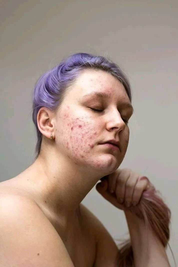 A young woman with purple hair and earrings, with acne scars on her face, is resting her head on her hand and has her eyes closed.