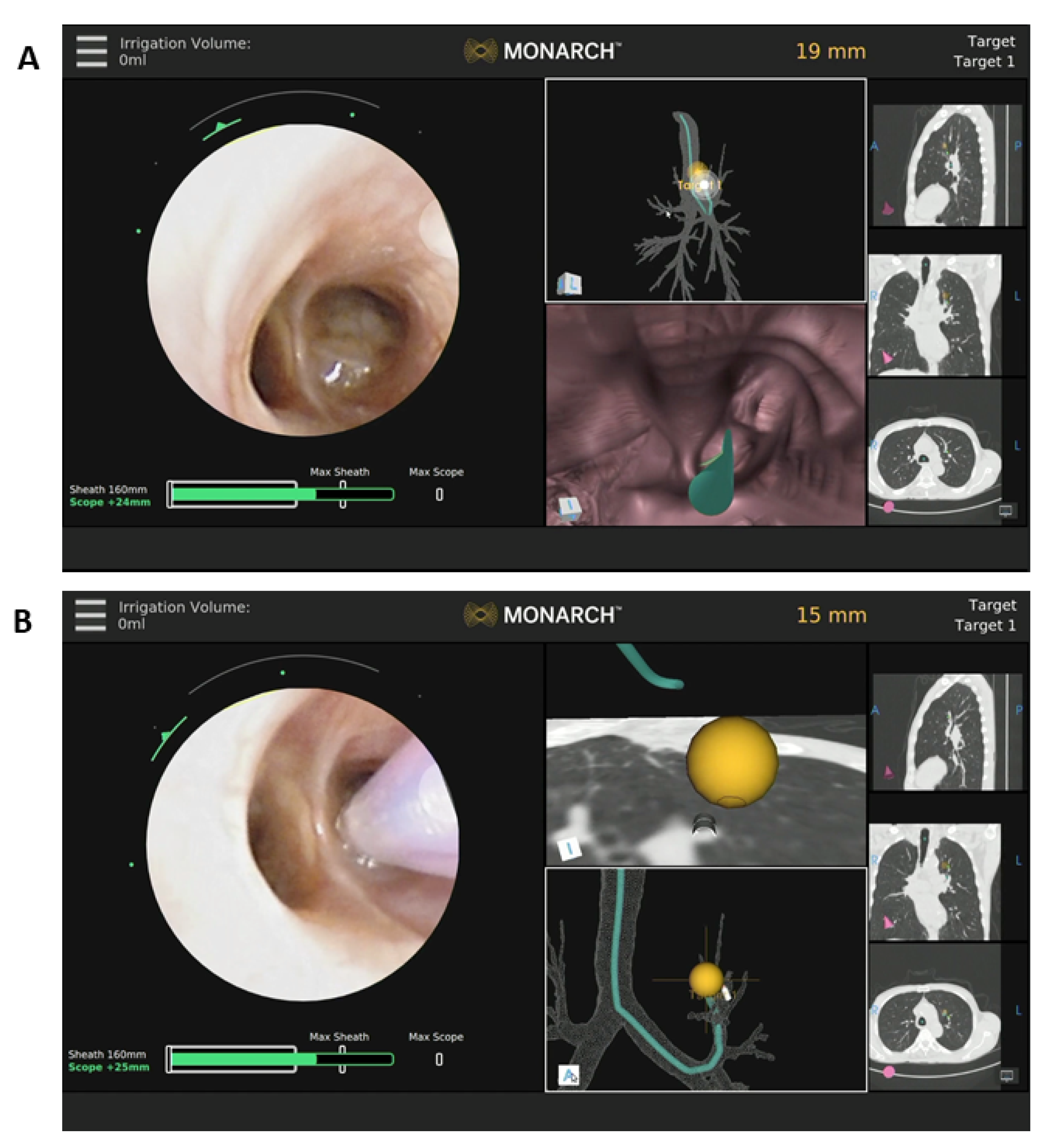 Lung Nodule Evaluation Using Robotic-Assisted Bronchoscopy at a Veteran’s Affairs Hospital