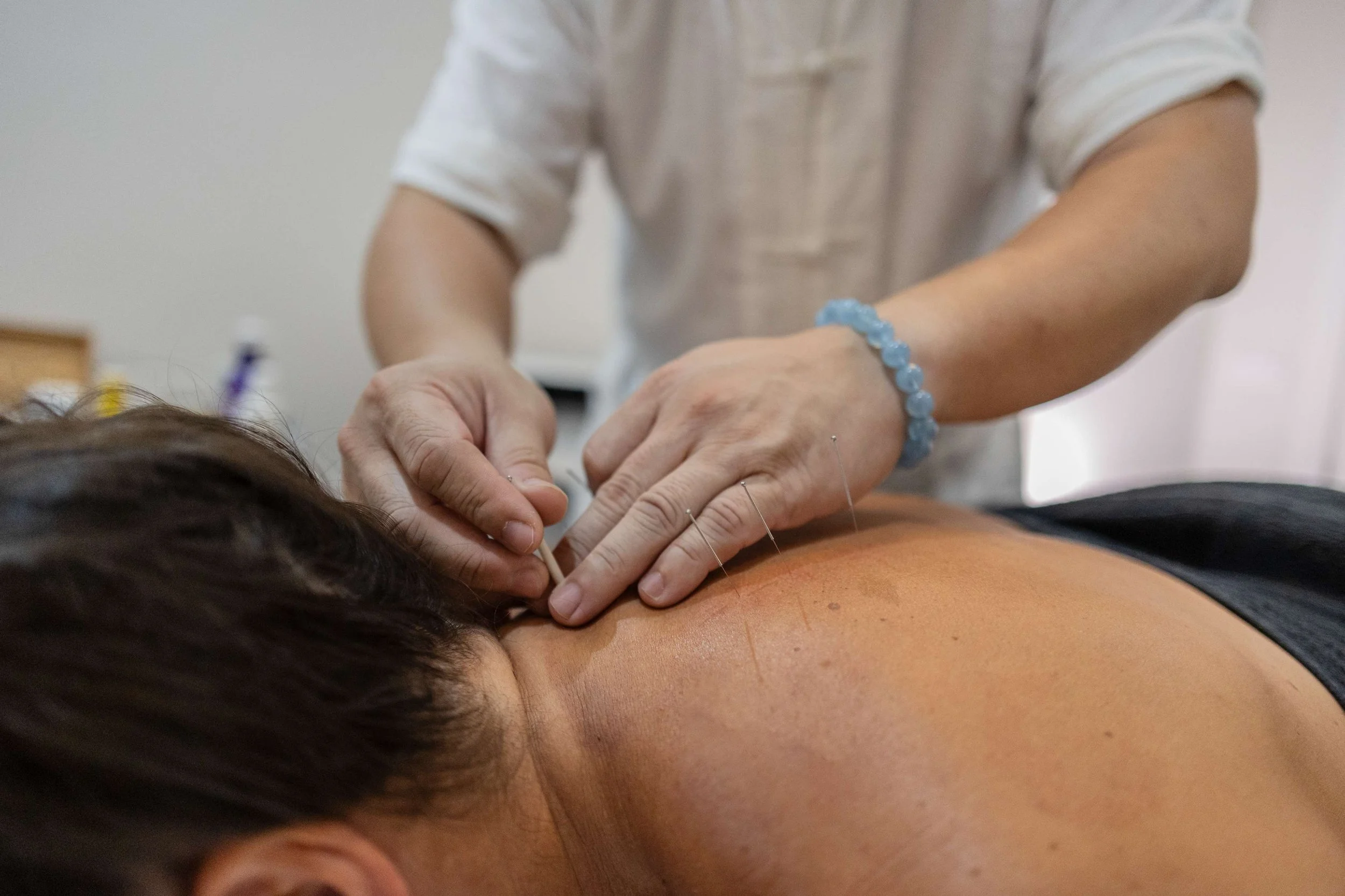 SAAM Acupuncture: The Gentle Korean Four-Needle Technique