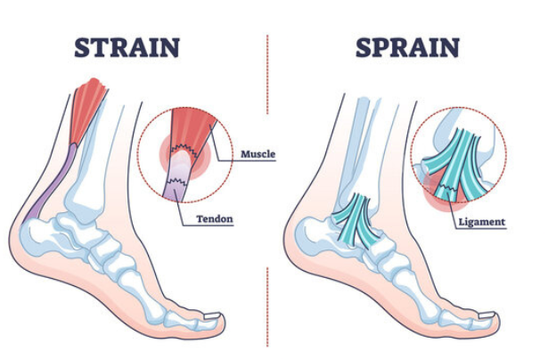 Understanding Strain vs. Sprain: What’s the Difference?