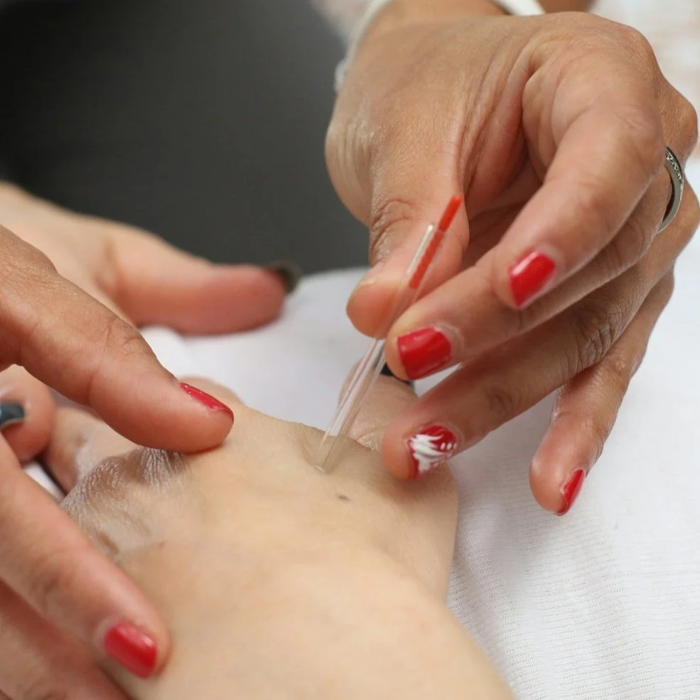 Acupuncture needle insertion for a headache treatment at Large Intestine 4. Acupuncture Winnipeg. 