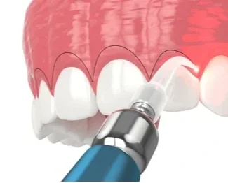 Gingivectomy
