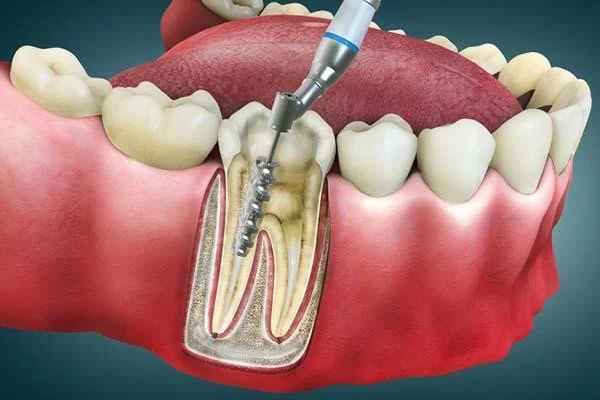 Root Canals