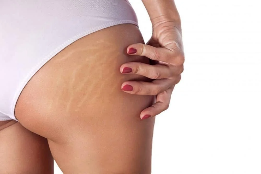 Microneedling for Stretch Marks: Does It Really Work?