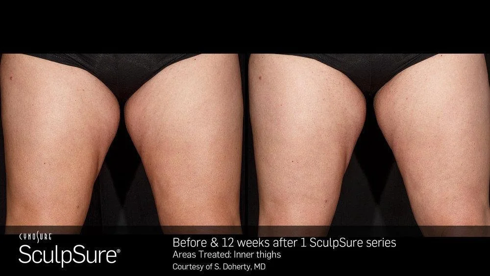 combat-stubborn-fat-with-warmsculpting-by-sculpsure_6596dbc544e30.jpeg