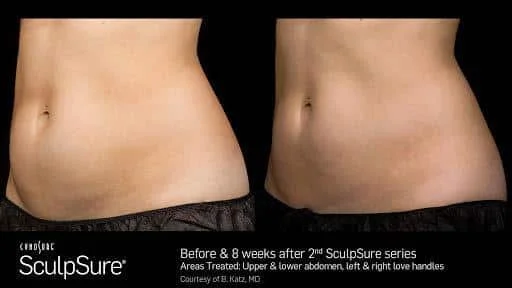 considering-lipo-in-fort-worth-try-warmsculpting-with-sculpsure-instead_6596e4254d322.jpeg