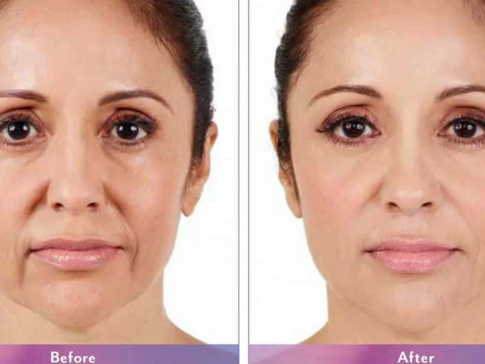 improve-your-appearance-with-juvederm_6596dbd079eff.jpeg