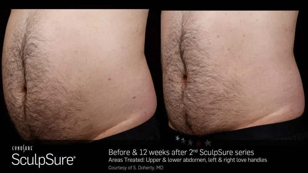 looking-for-a-non-surgical-alternative-to-liposuction-try-warmsculpting-with-sculpsure_6596dbb1ec992.jpeg