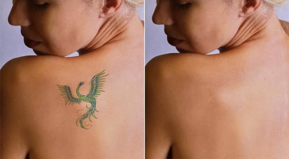 Does Tattoo Color Matter? How Ink Colors Affect Removal