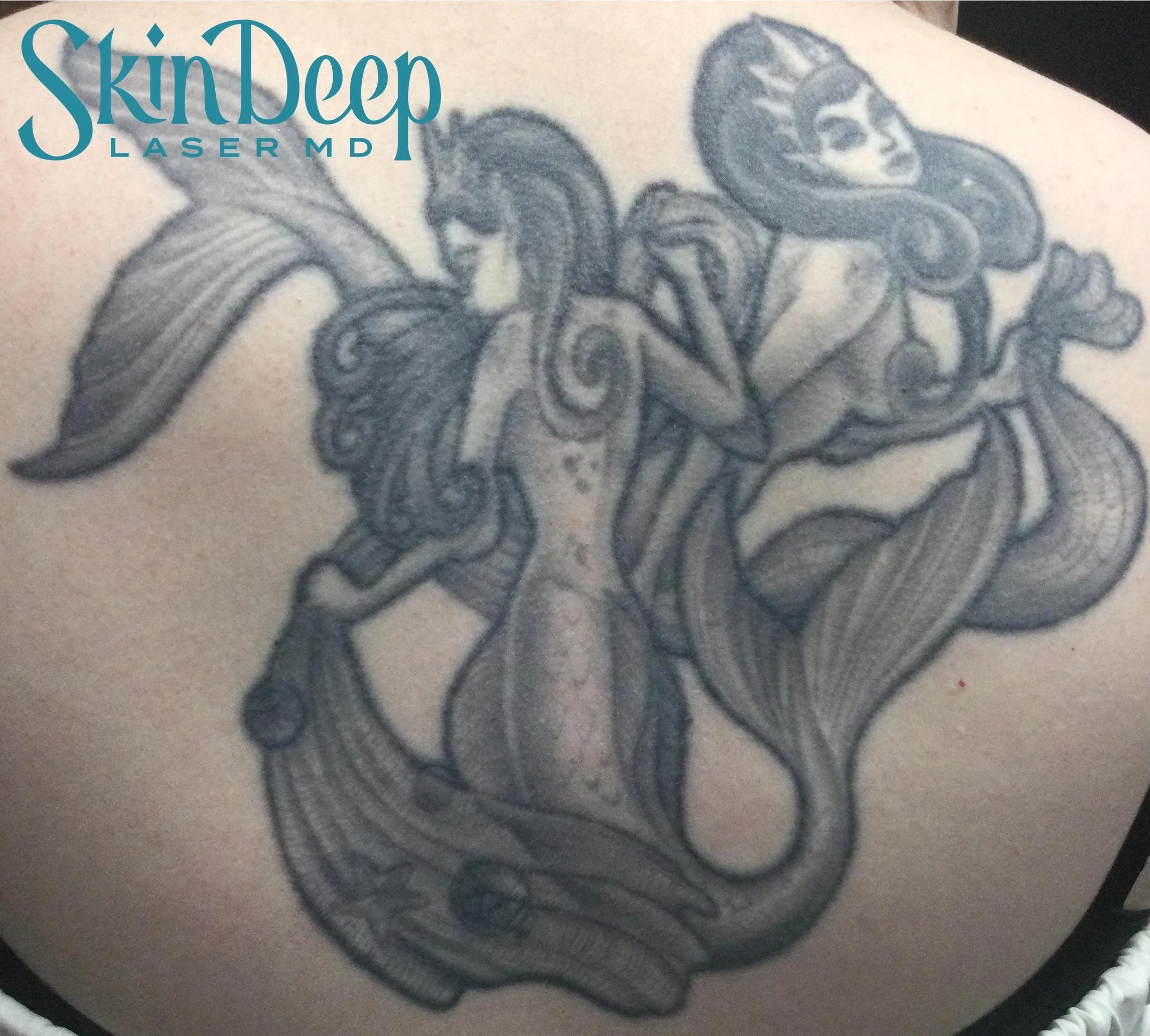 Pt 001 Tattoo Before.jpg