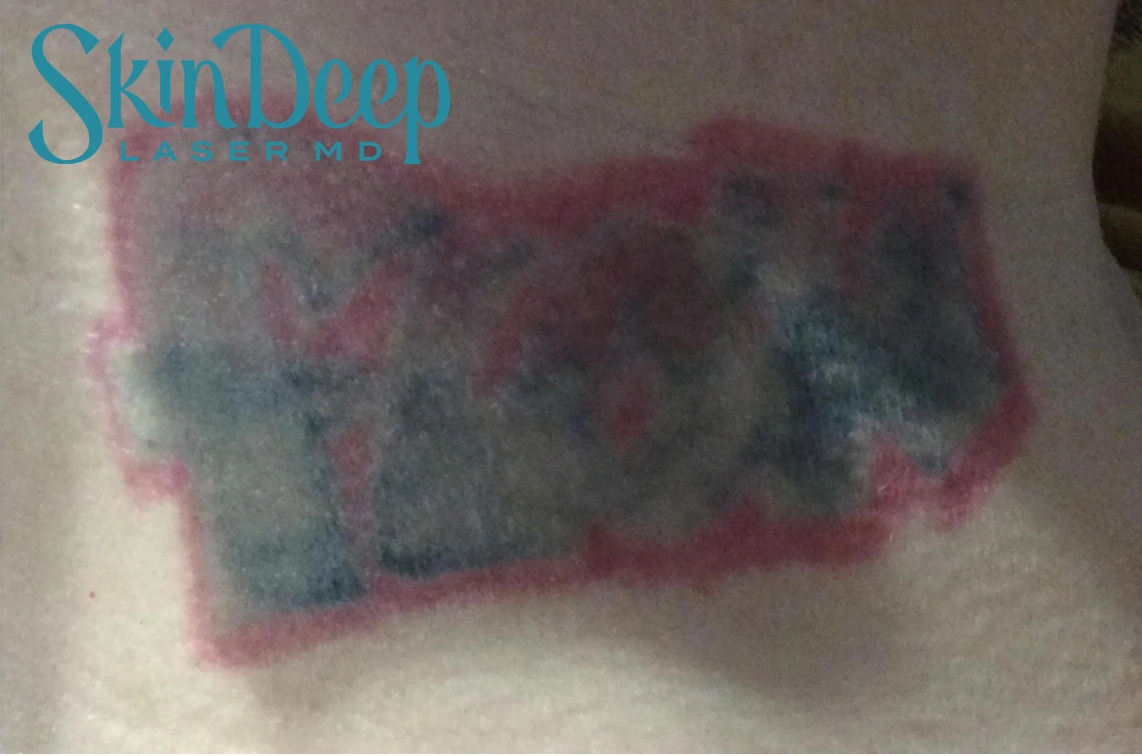 Pt 002 Tattoo1 Before.jpg