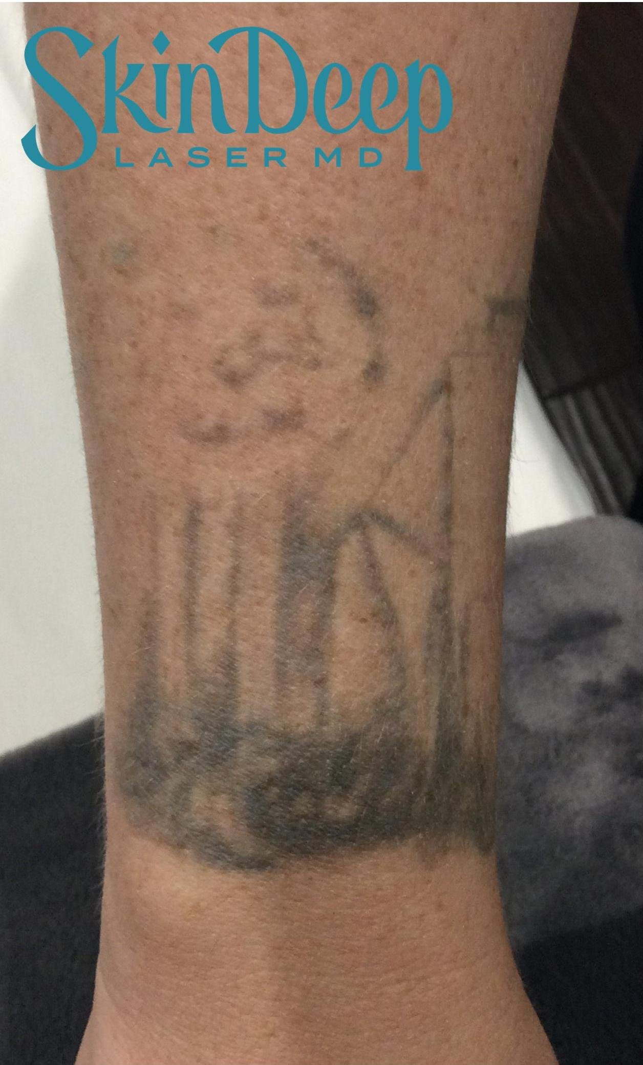 Pt 002 Tattoo2 Before.jpg