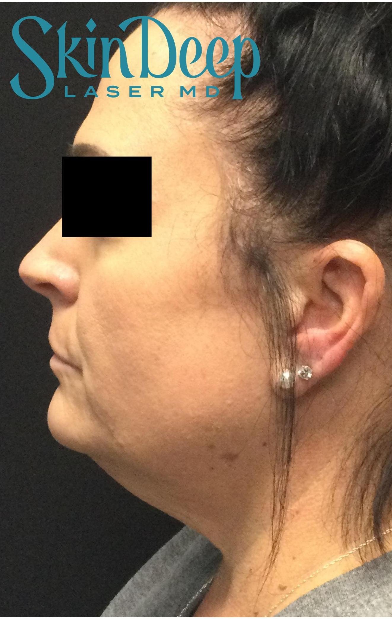 Pt 003 Subm Before.jpg