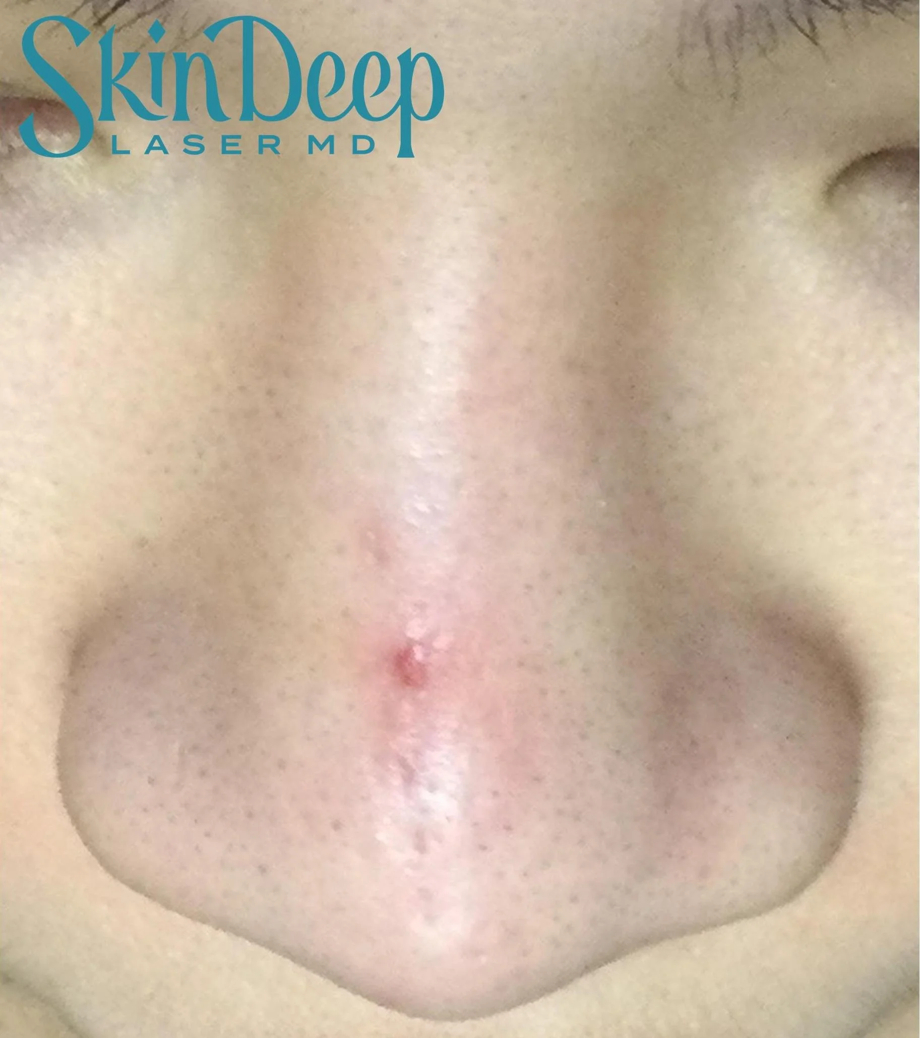 Pt 004 Scar Before.jpg