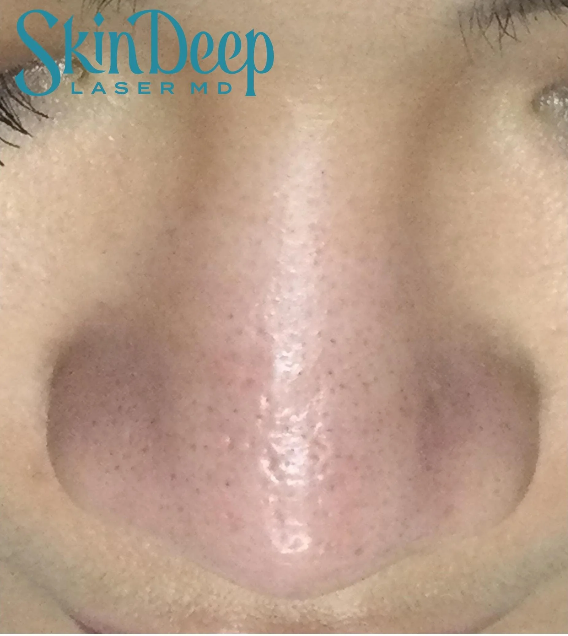 Pt 004 Scar Post Tx.jpg