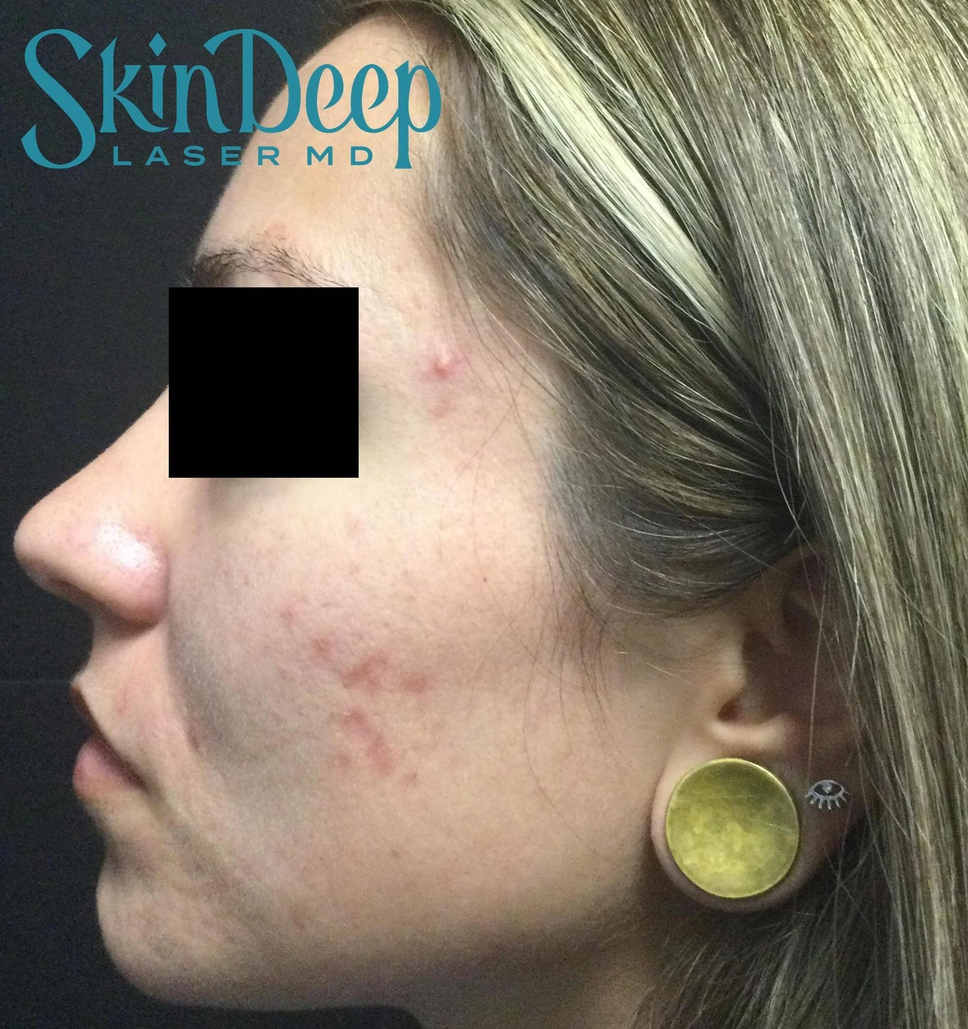 Pt 006 Acne Scar Before.jpg