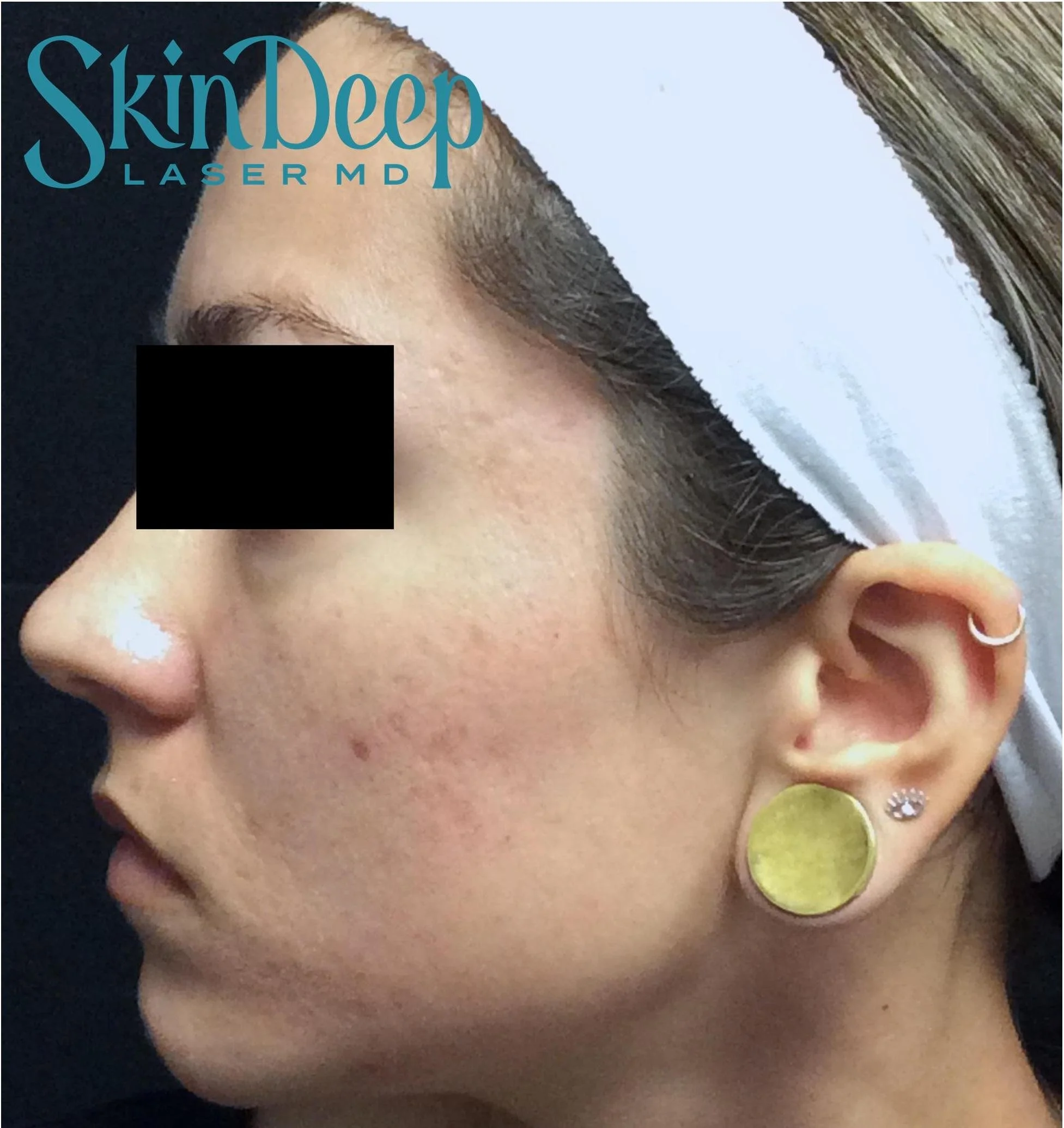 Pt 006 Acne Scar Post 2 Tx.jpg