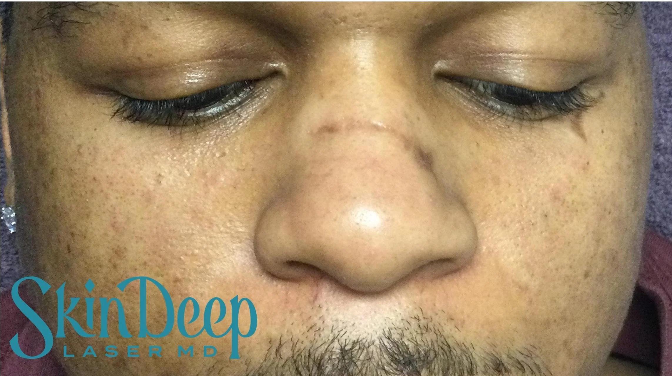 Pt 007 Scar Before.jpg