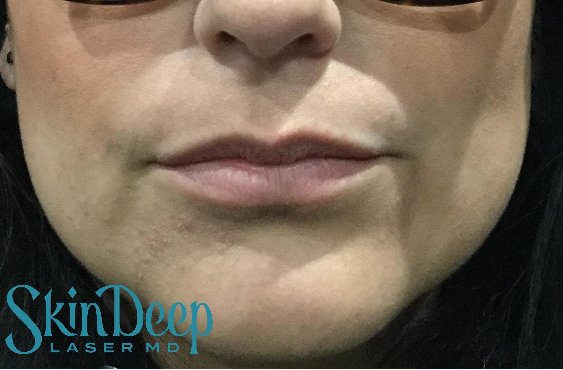 PT 008 Lip Aug Before.jpg