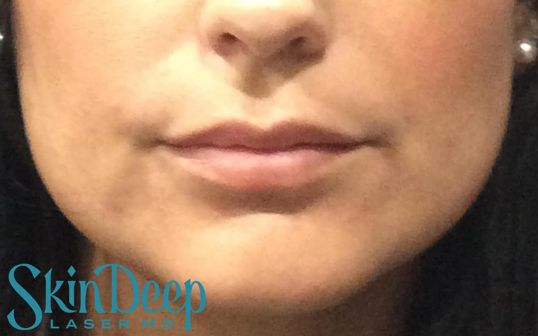 Pt 008 Lip Aug Post.jpg