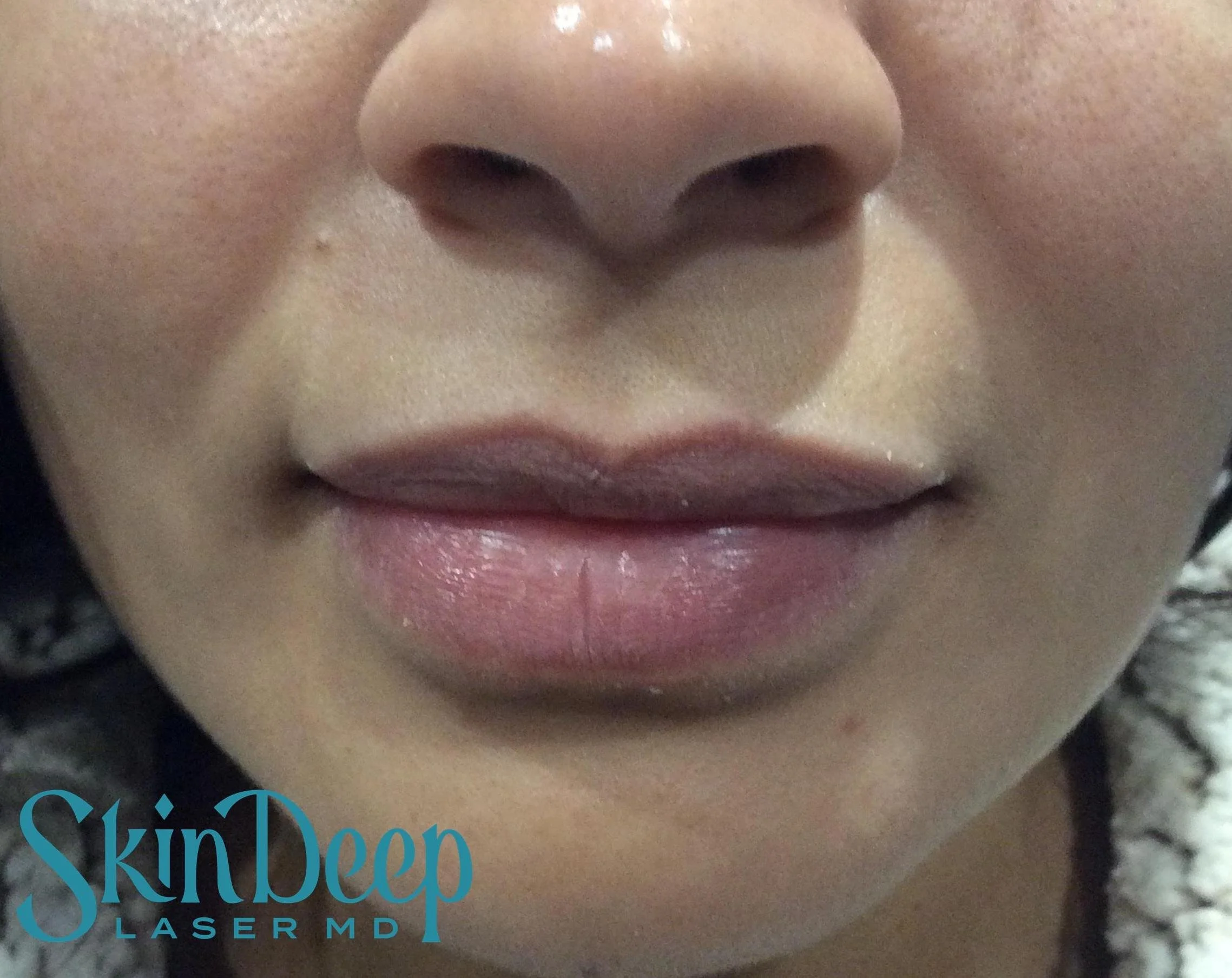 Pt 009 Lip Aug Before.jpg