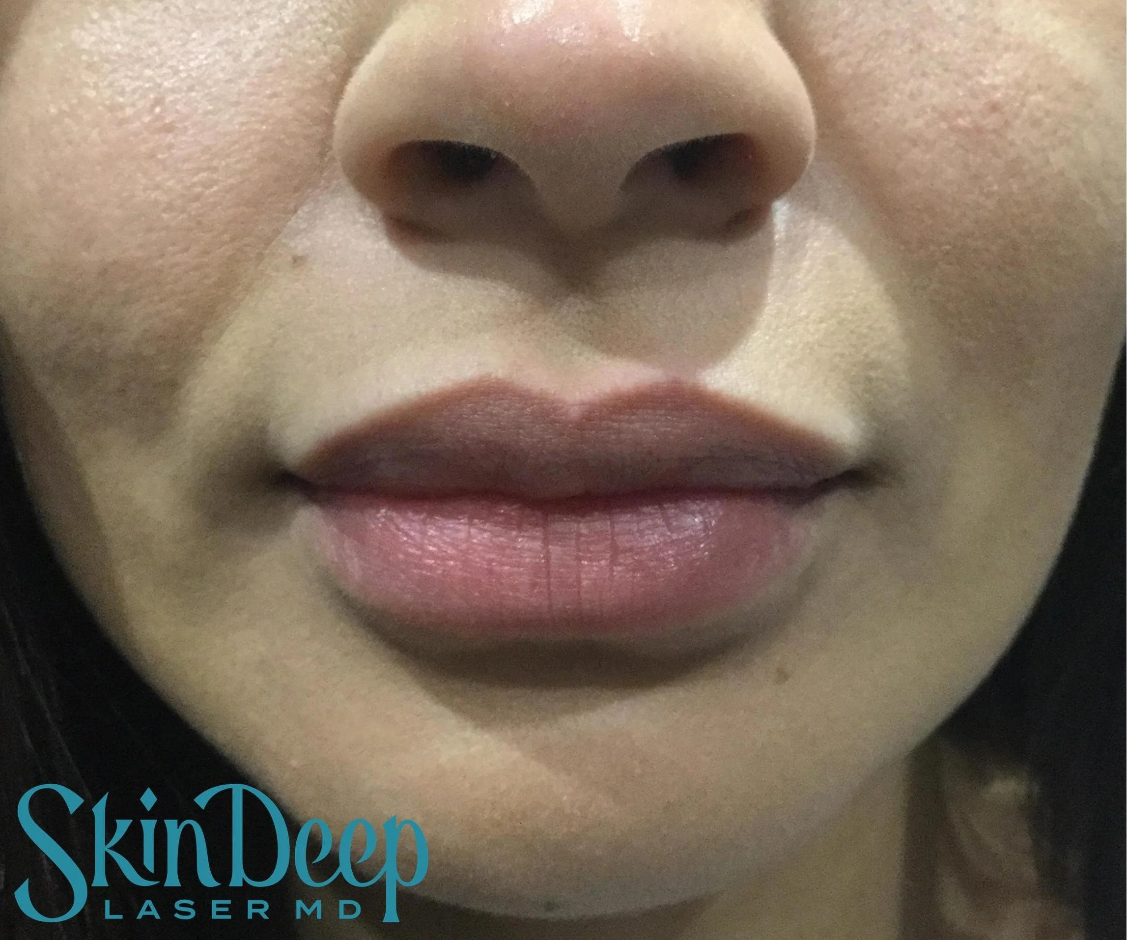 Pt 009 Lip Aug Post.jpg