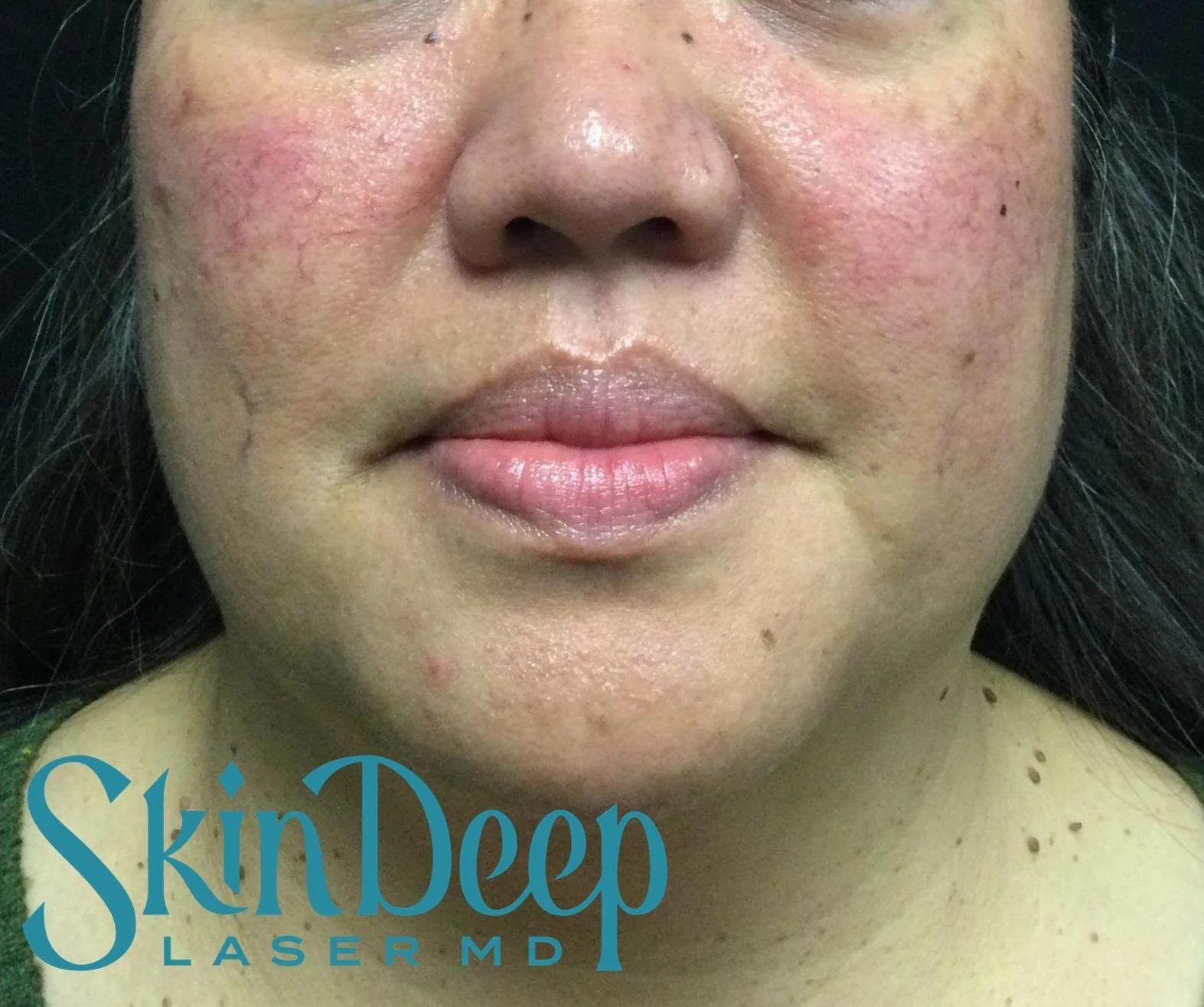 Pt 010 IPL Before.jpg