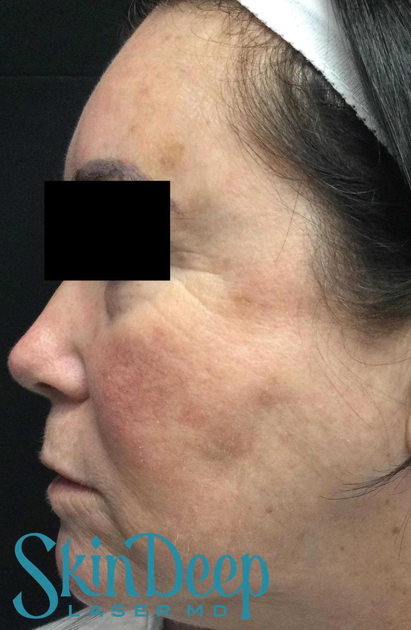Pt 012 Pigment Before.jpg