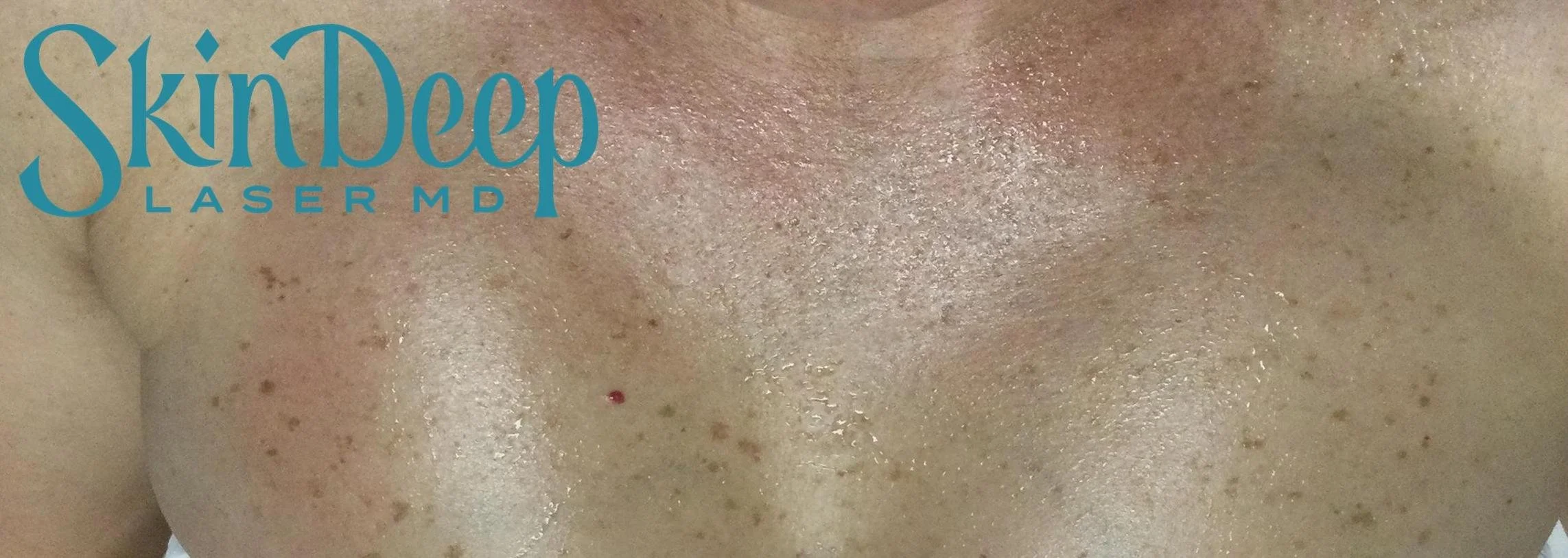 PT 014 IPL Redness Before.jpg