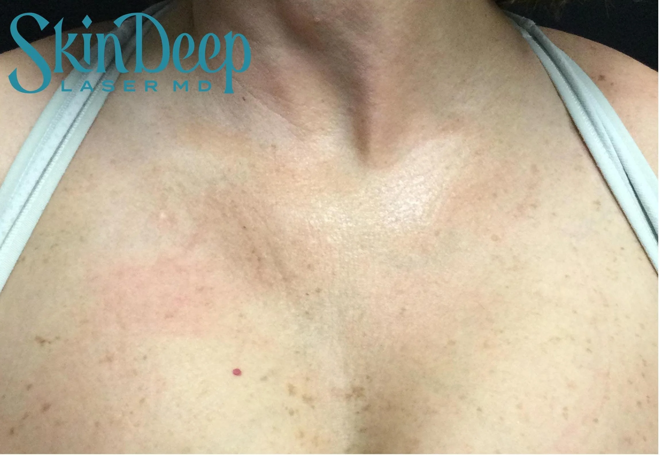 PT 014 IPL Redness Post 1 Tx.jpg