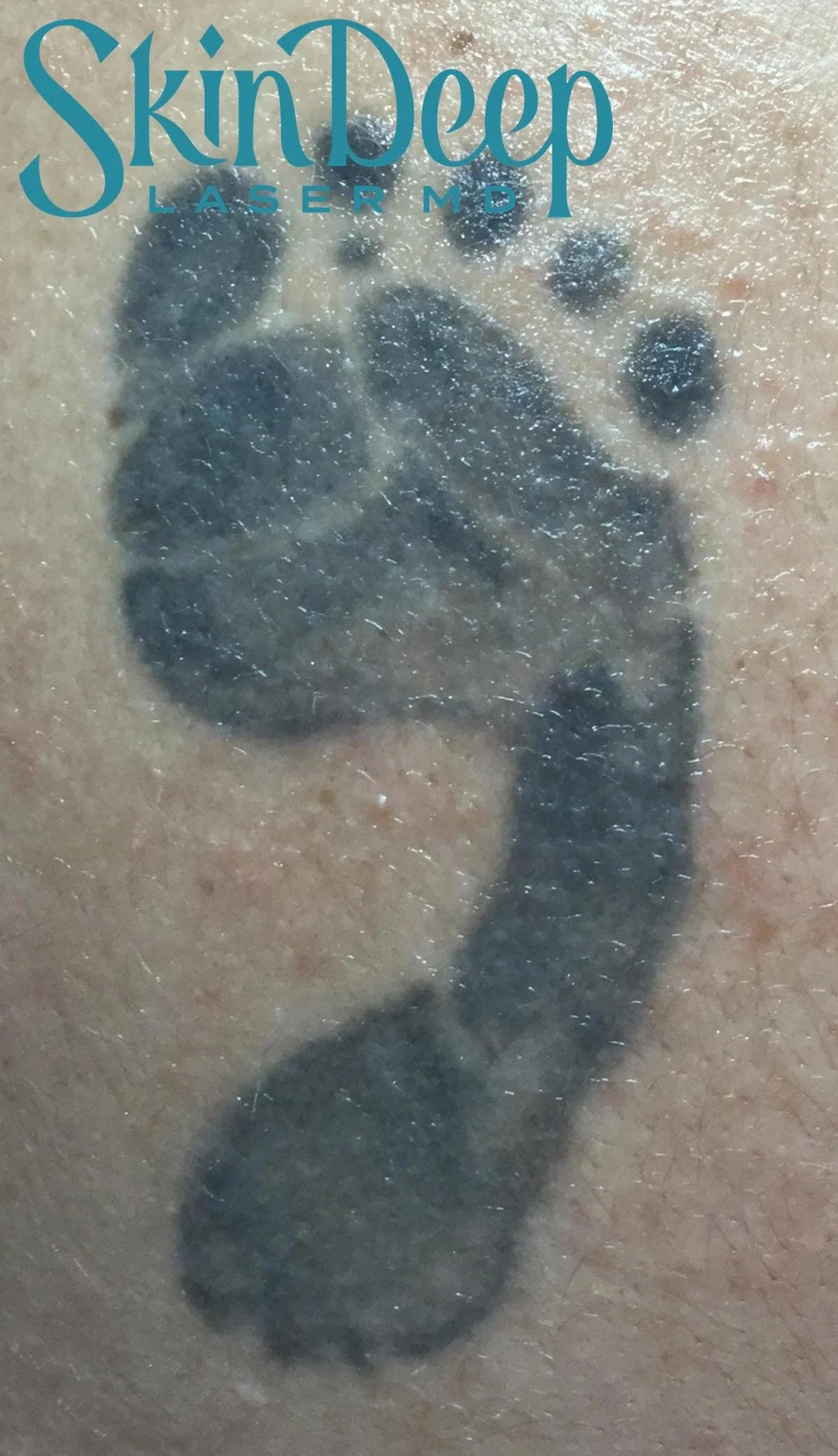 Pt 015 Tattoo Before.jpg