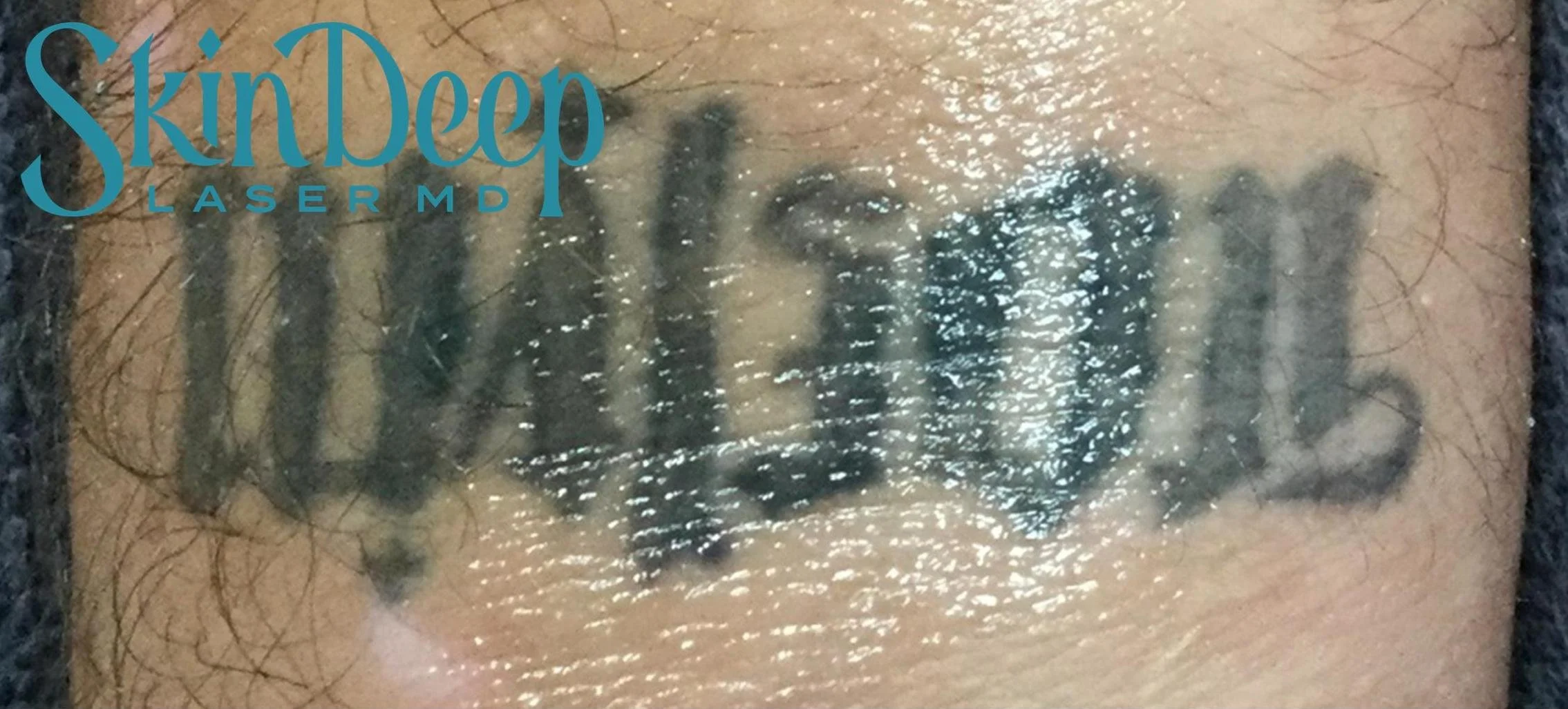 Pt 016 Tattoo Before.jpg