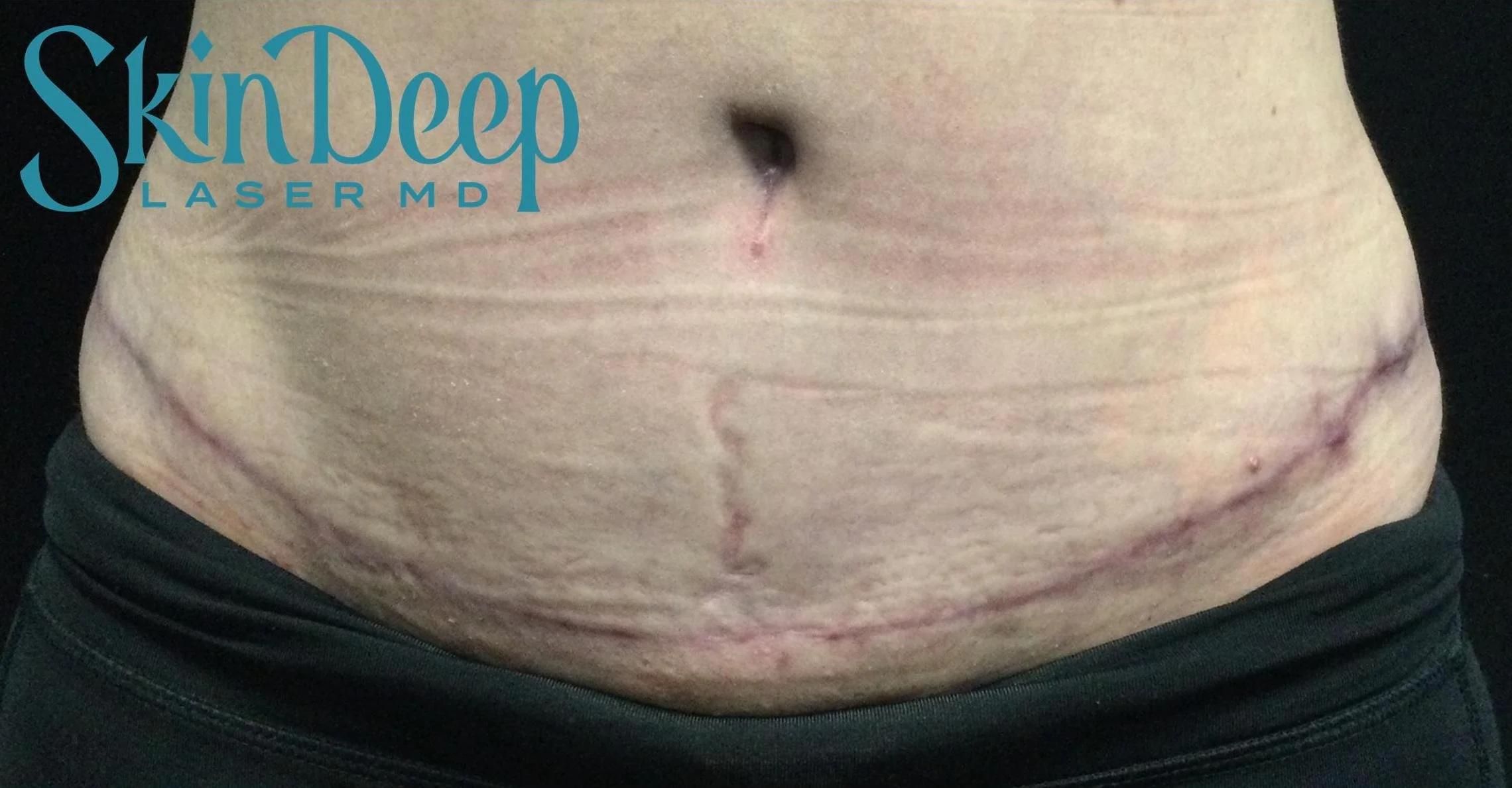Pt 017 Scars Before.jpg