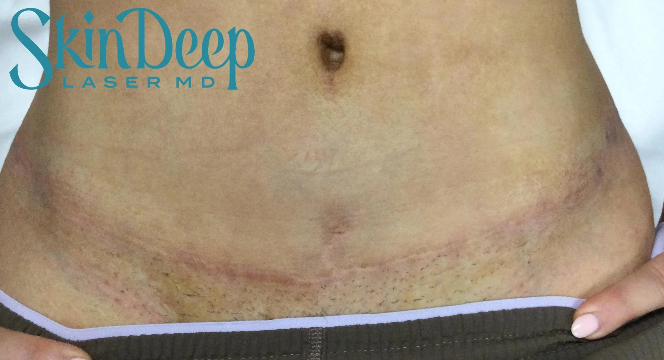 Pt 017 Scars Post 6 Tx.jpg