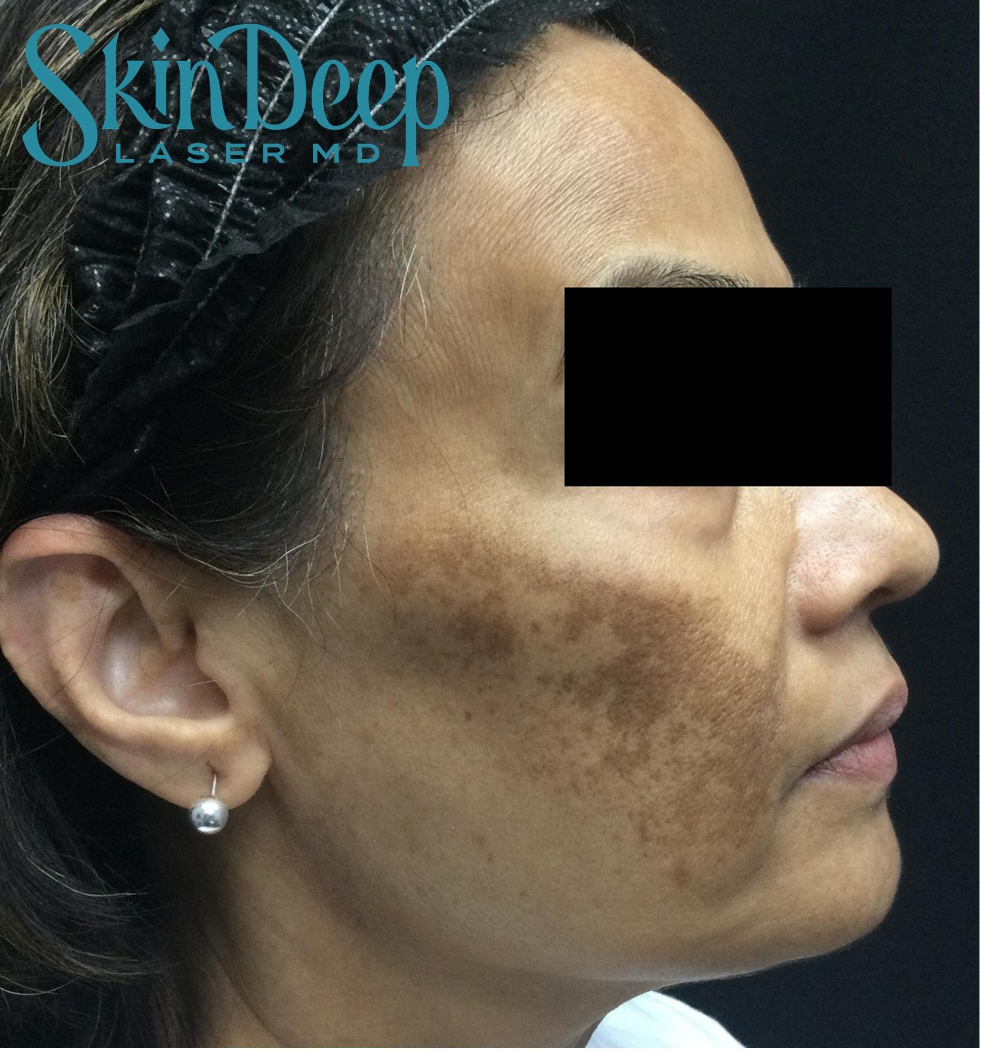 Pt 018 Melasma Before.jpg