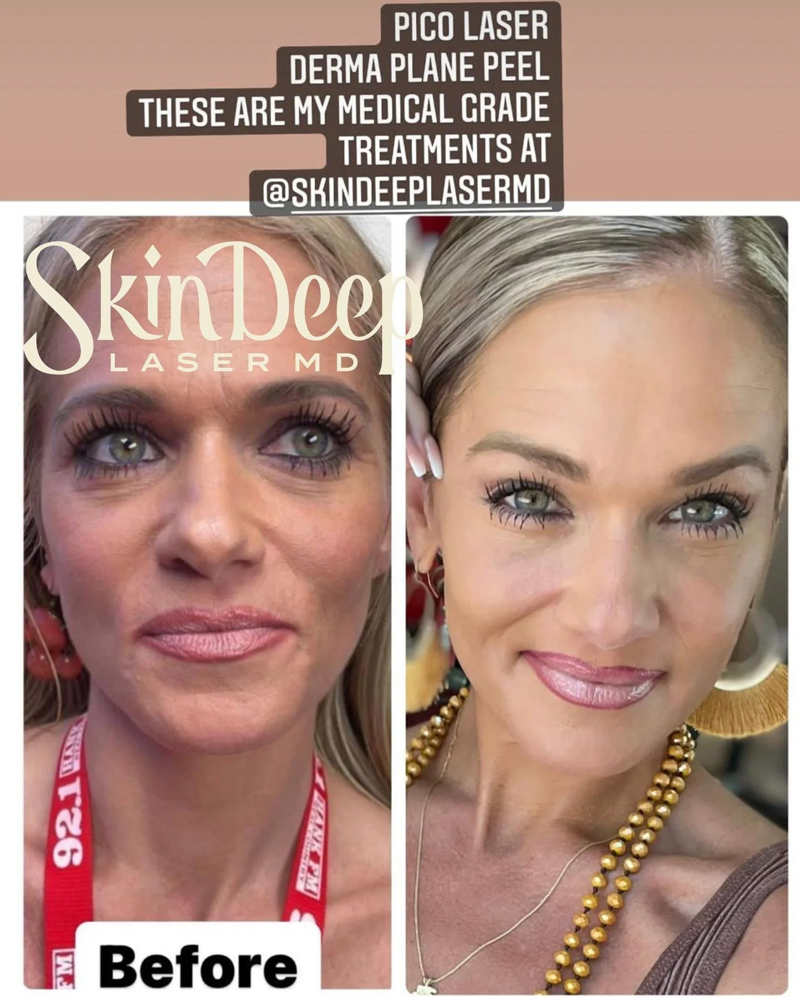 PT 019 Chem Peel Club1.jpg