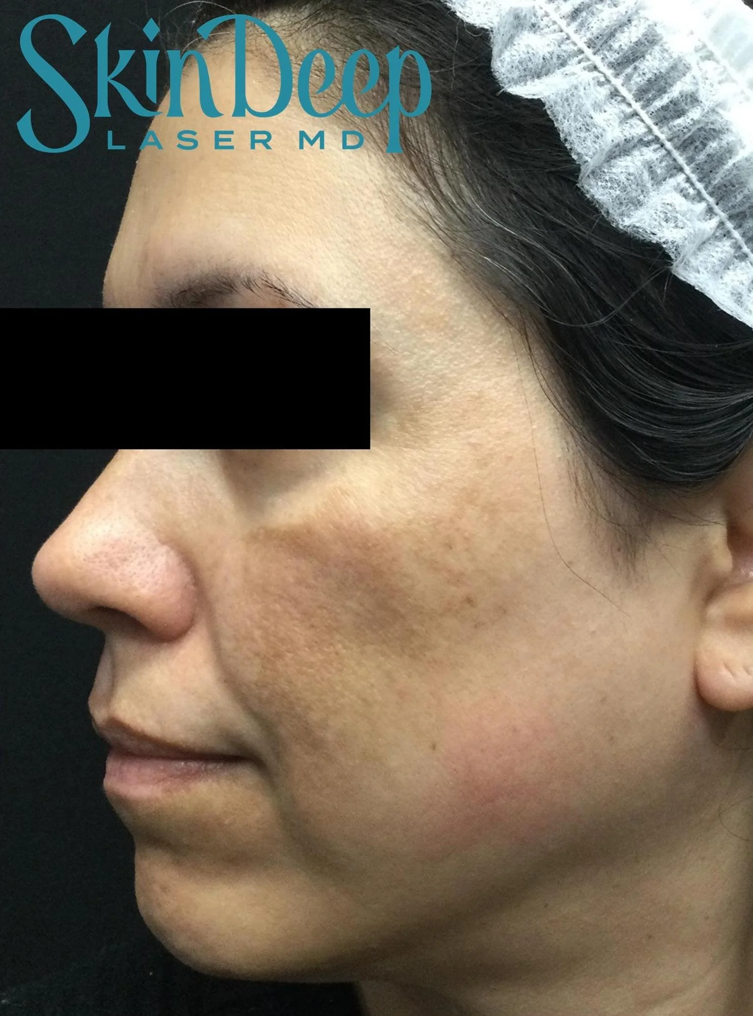 Pt 023 Pigment Before.jpg
