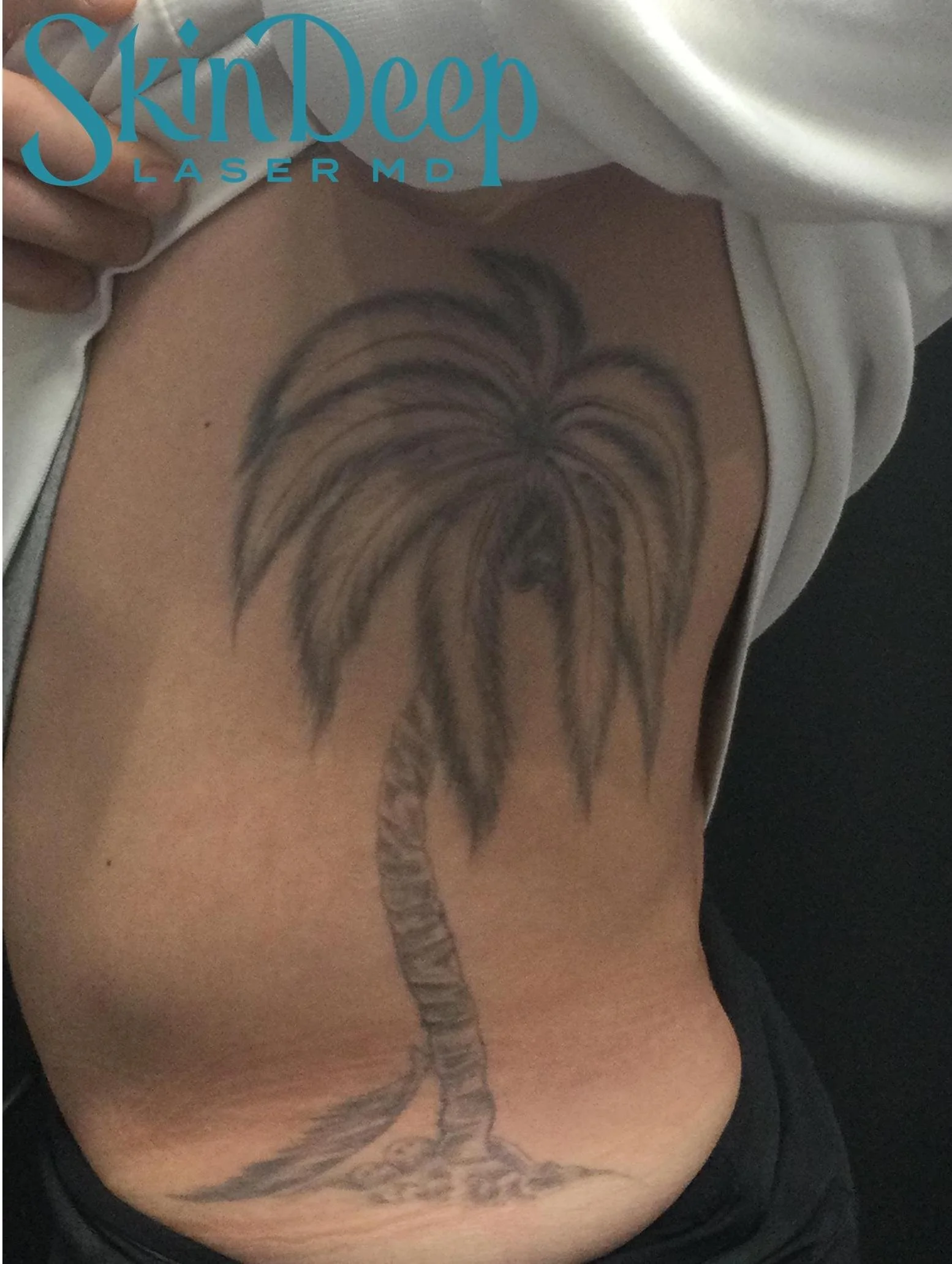 Pt 024 Tattoo Before.jpg