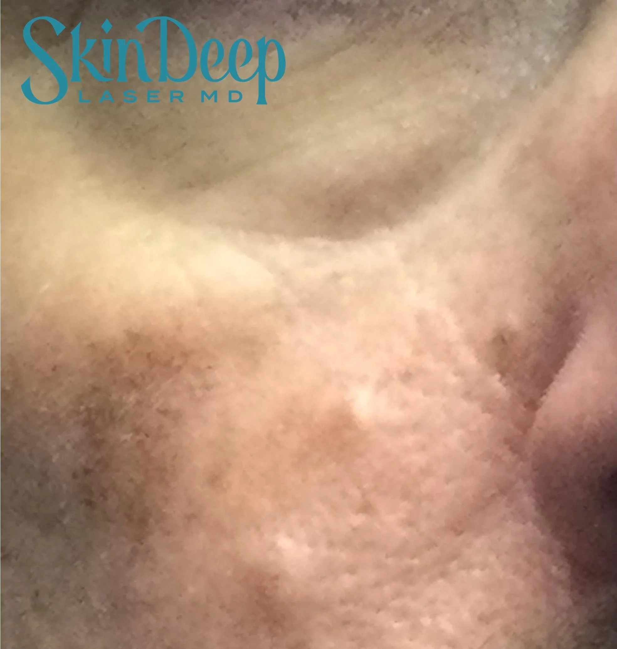PT 025 IPL Pigment Before.jpg
