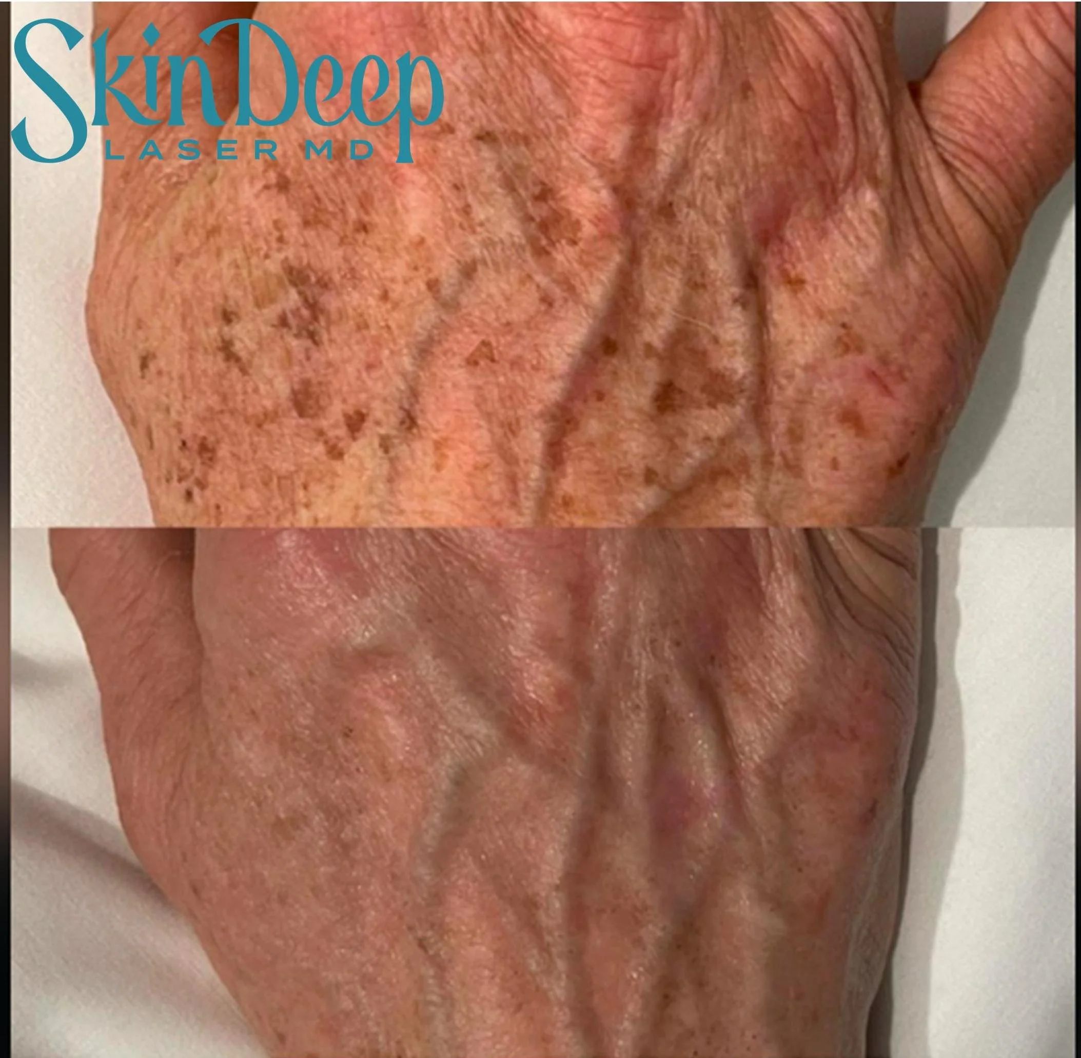 PT 027 Hand Rejuvenation Pico.jpg