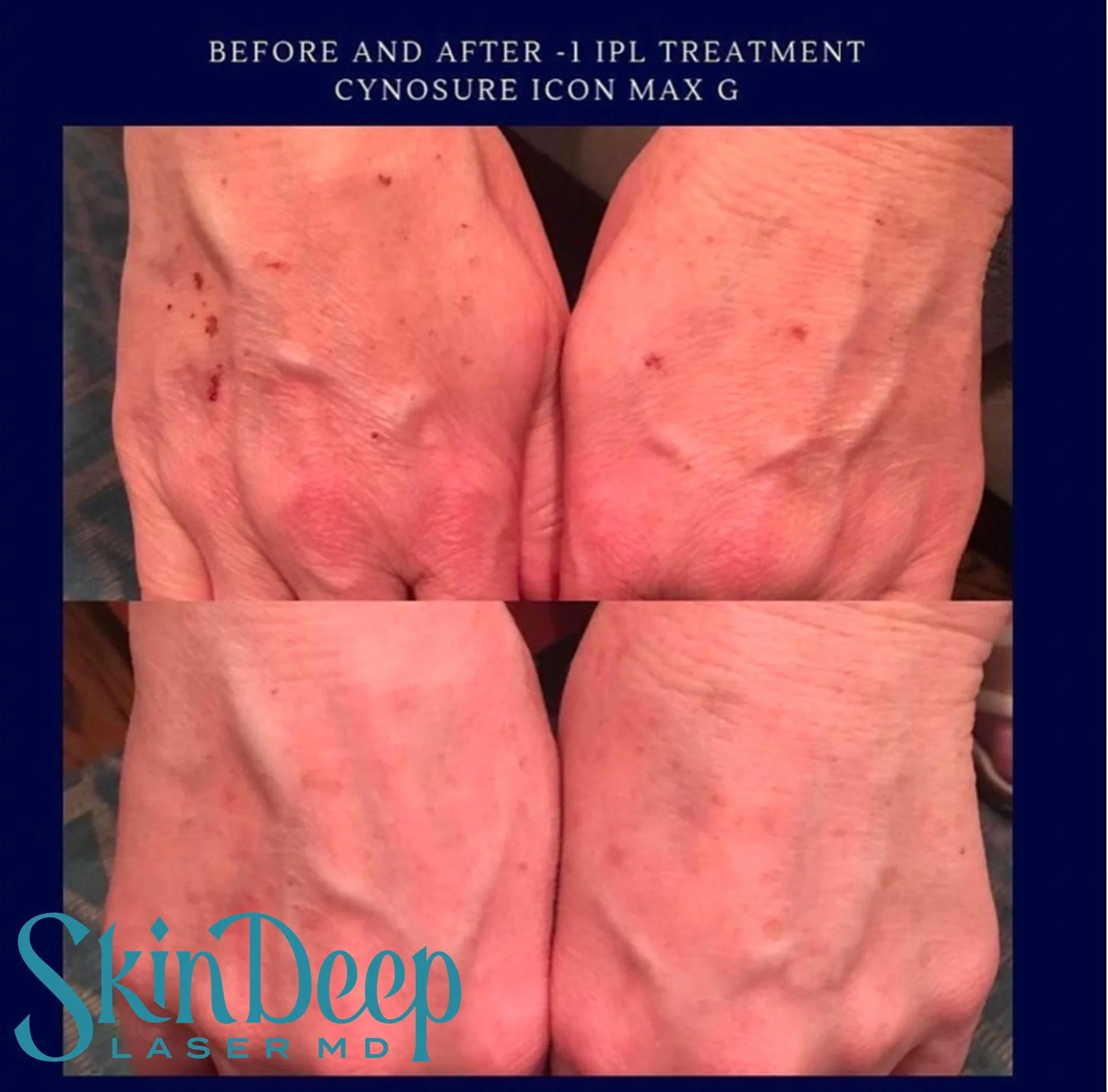 PT 028 Hand Rejuvenation IPL.jpg