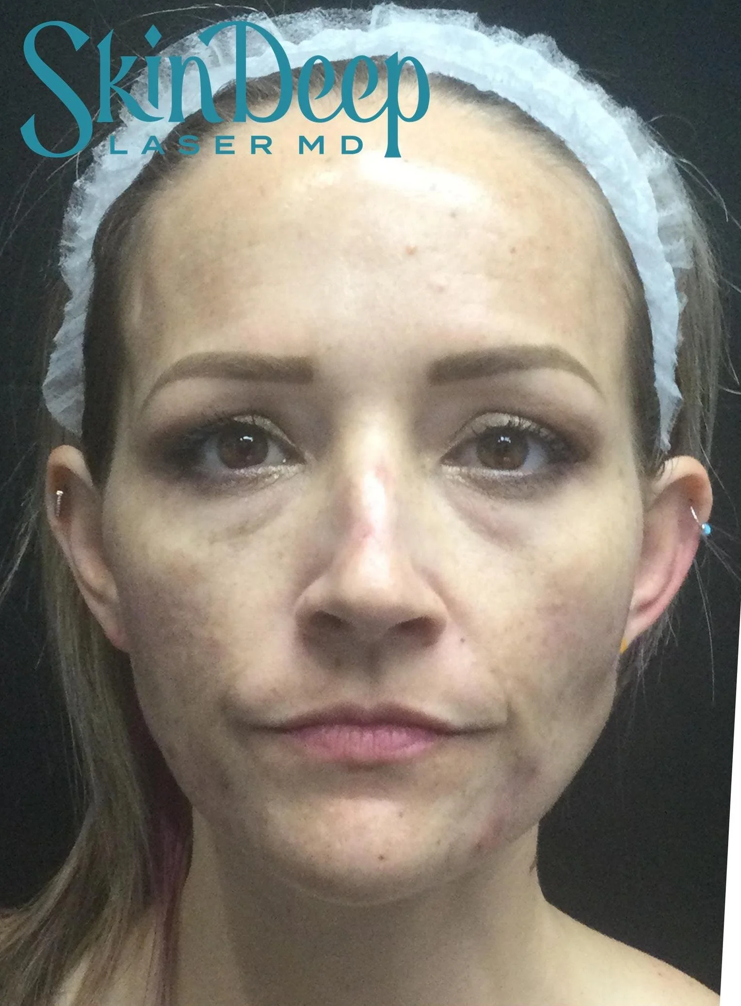 PT 029 Peel Pgm After.jpg